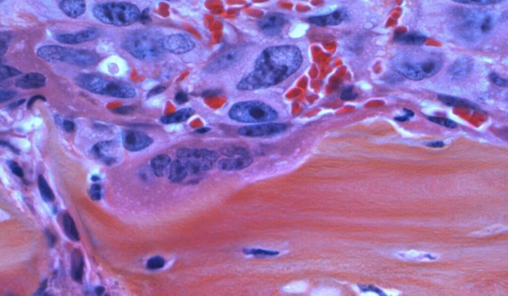 FDA Approves New Neuro-Oncology Device